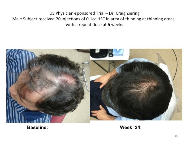 Replicel  The End of Hair Loss and Balding by 2020